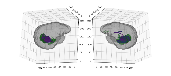 3-D Segmentation of Brain MRIs